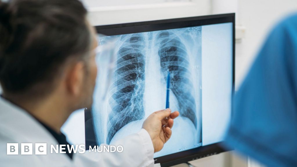 El papa León XIV supera con éxito una cirugía torácica tras detectársele un adenocarcinoma pulmonar
